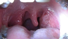 Boğaz Şişkinliği Belirtileri ve Tedavisi